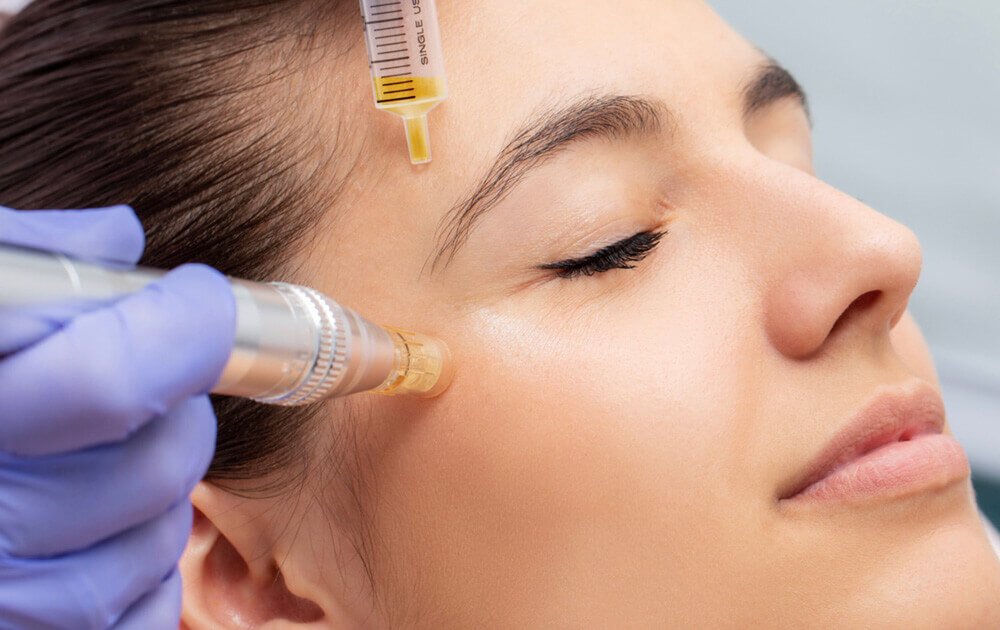 PRP WITH MICRONEEDLING | Meraki Aesthetics and Company PLLC | Cornelius, NC