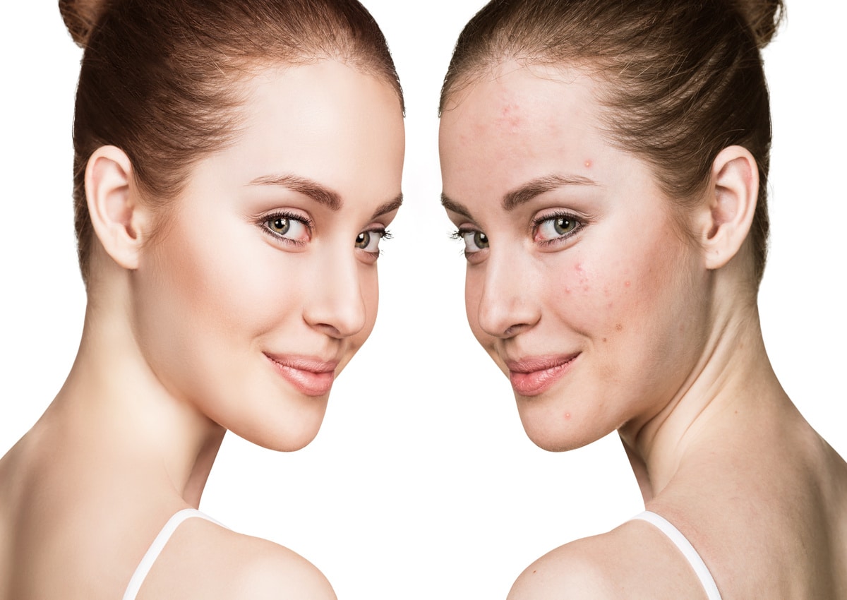 Sculptra for Acne Scars: Can It Help Smooth Out Skin Texture and Scarring? | Meraki Aesthetics and Company PLLC | Cornelius, NC