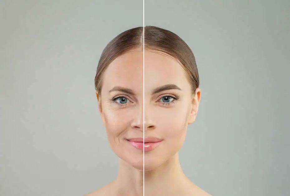 Ultherapy in Cornelius, NC by Meraki Aesthetics and Company