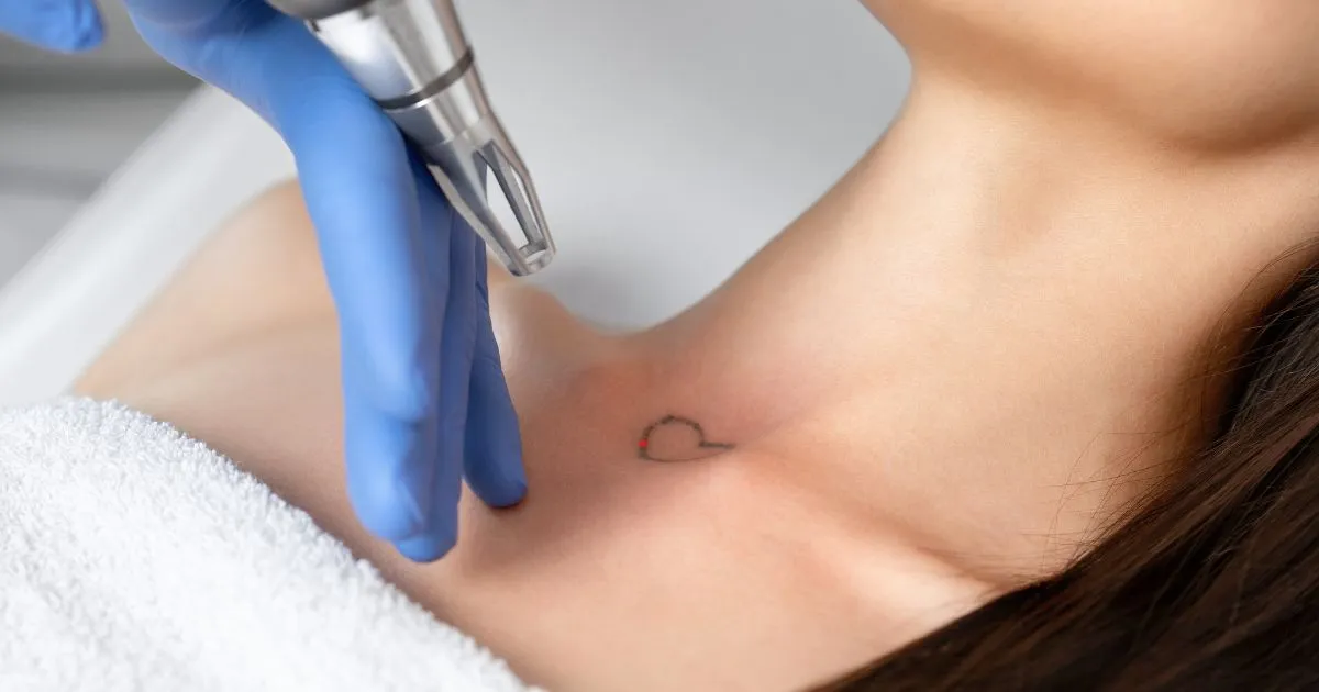 Meraki Aesthetics and Company, providing laser tattoo removal in Cornelius, NC