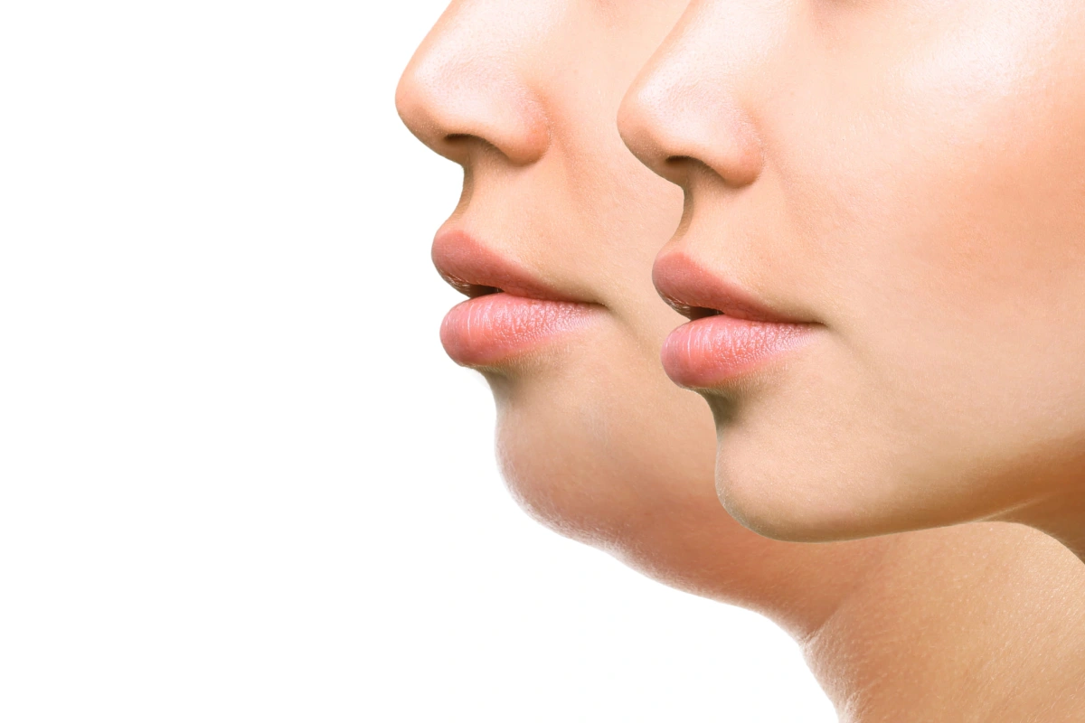 Woman showing visible results after Kybella treatment in Cornelius, NC, with reduced double chin fat and a more defined jawline profile.